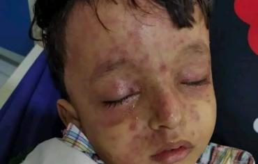 "حرب بيولوجية إمامية" تعيد اليمن الى زمن الأوبئة.. "الحصبة" تواصل حصد أرواح الأطفال