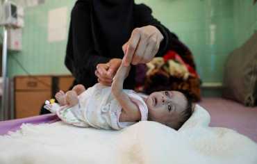 سوء التغذية الحاد يرتفع بين الأمهات والأطفال اليمنيين